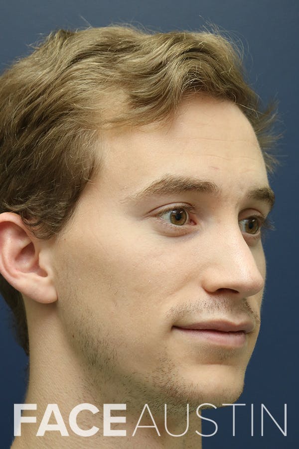 Rhinoplasty Before & After Gallery - Patient 24221128 - Image 4
