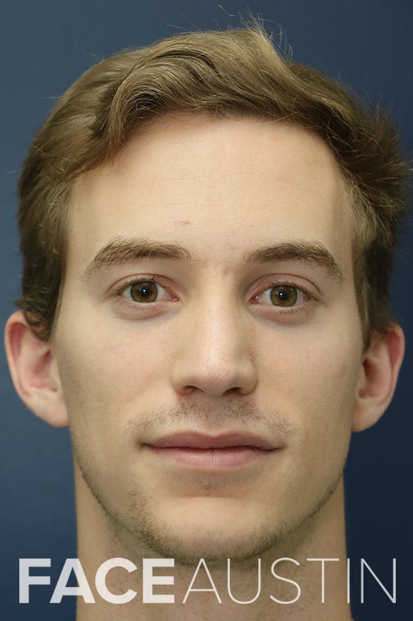 Rhinoplasty Before & After Gallery - Patient 24221128 - Image 6