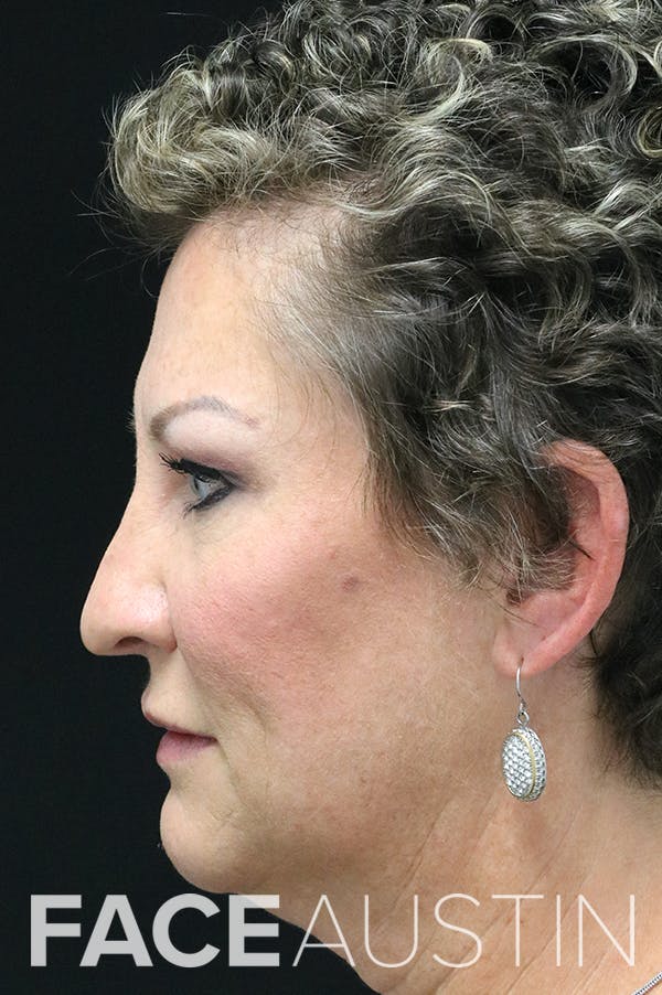 Rhinoplasty Before & After Gallery - Patient 24221129 - Image 1