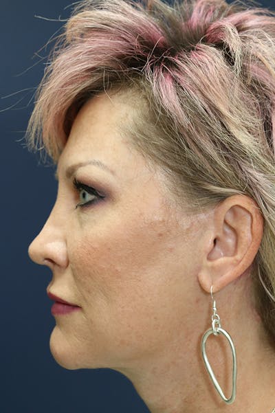Rhinoplasty Before & After Gallery - Patient 24221129 - Image 2
