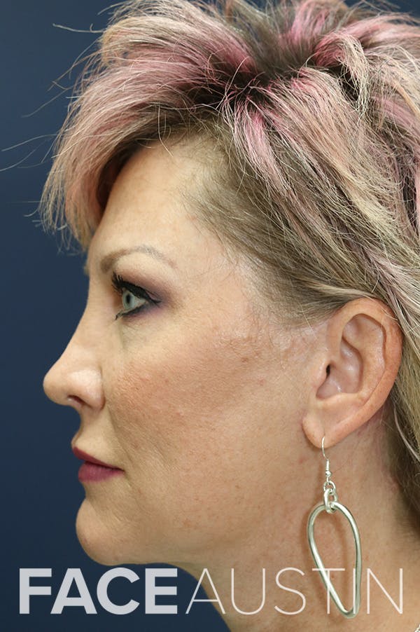 Rhinoplasty Before & After Gallery - Patient 24221129 - Image 2