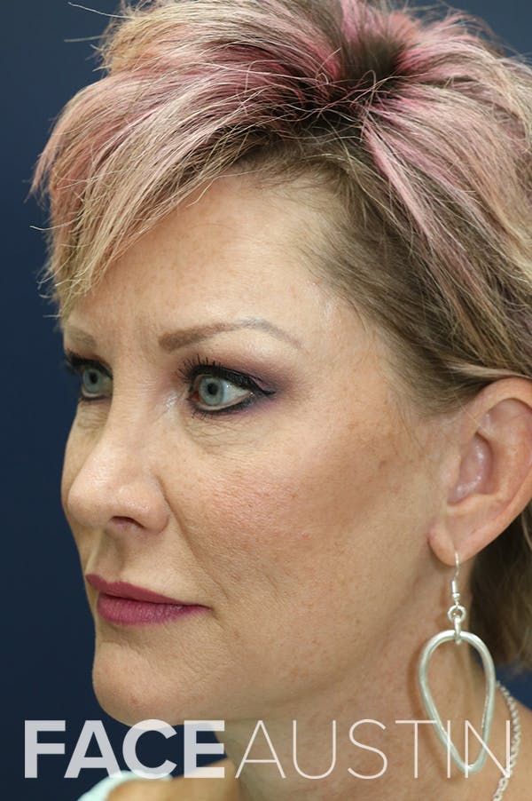 Rhinoplasty Before & After Gallery - Patient 24221129 - Image 4