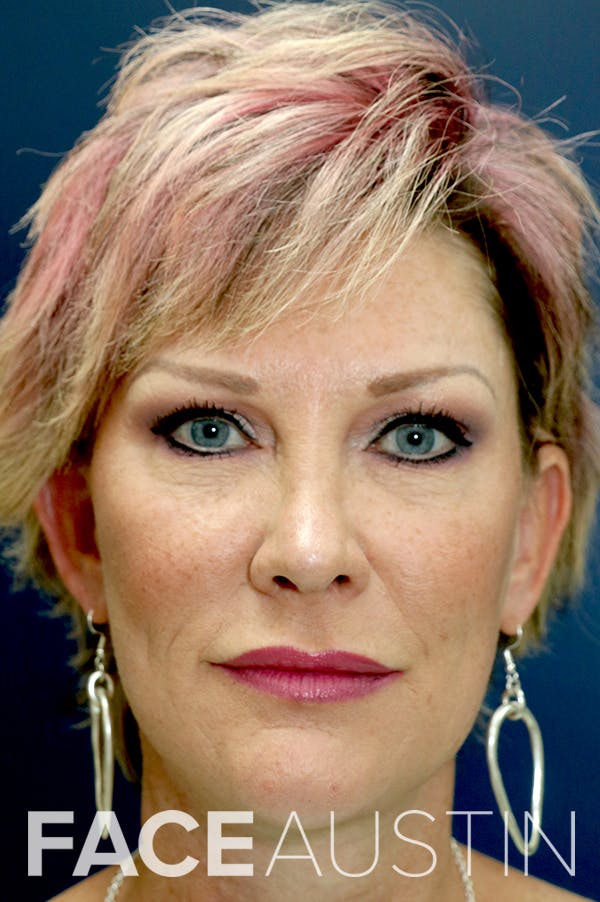 Rhinoplasty Before & After Gallery - Patient 24221129 - Image 6