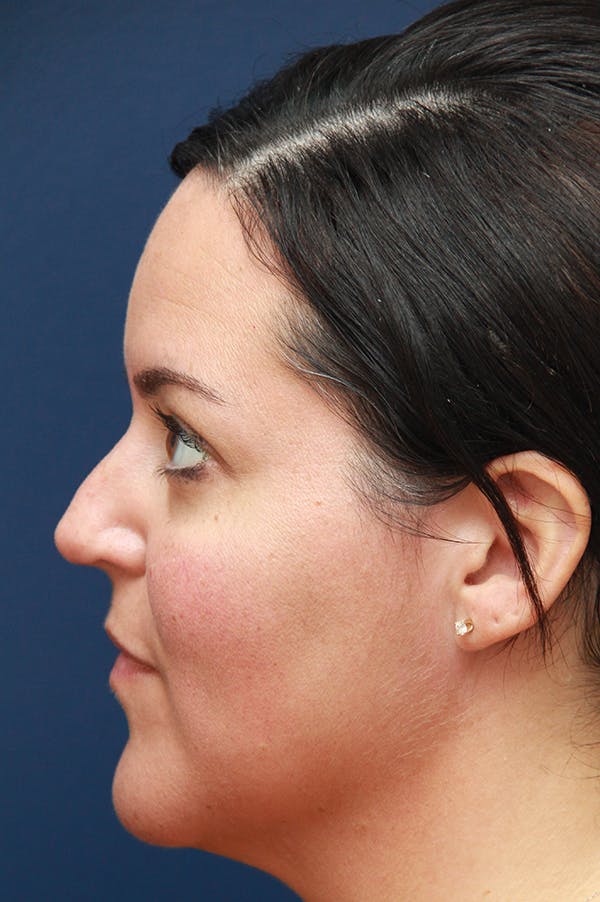 Revision Rhinoplasty Before & After Gallery - Patient 24222643 - Image 1