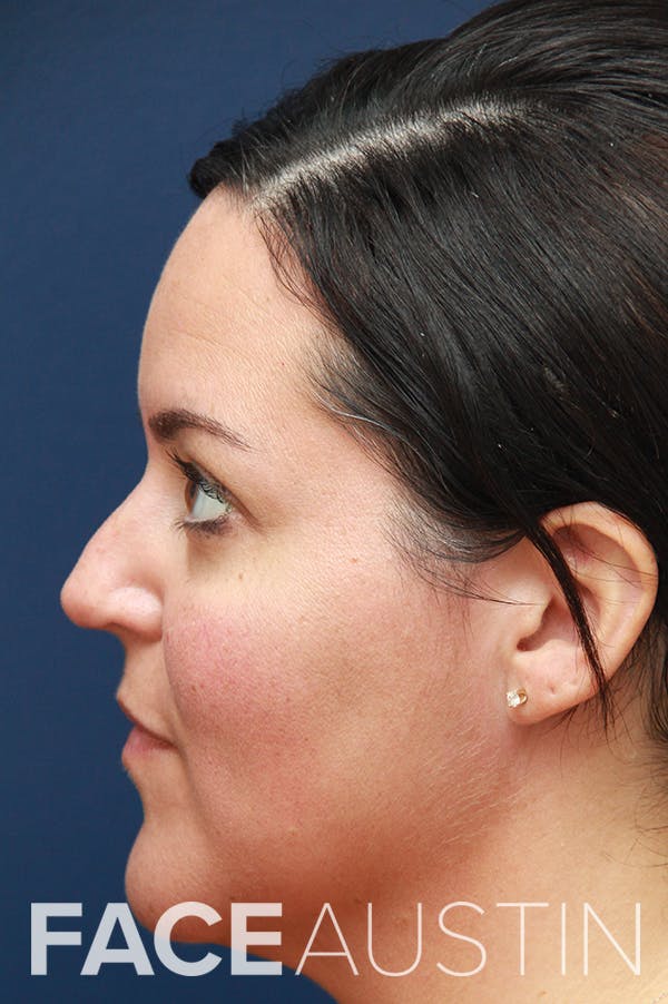 Revision Rhinoplasty Before & After Gallery - Patient 24222643 - Image 1