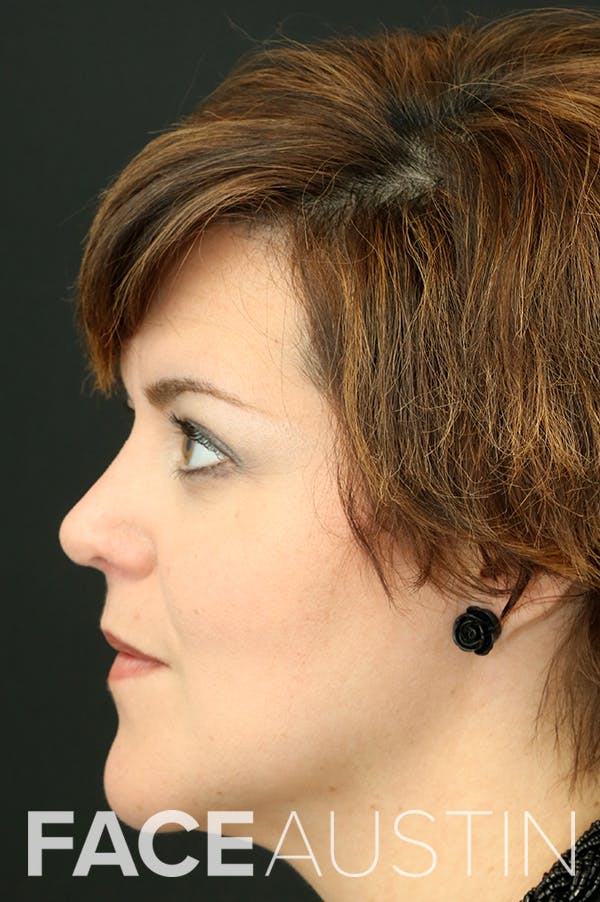 Revision Rhinoplasty Before & After Gallery - Patient 24222643 - Image 2