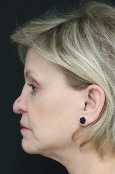 Revision Rhinoplasty Before & After Gallery - Patient 24222644 - Image 1