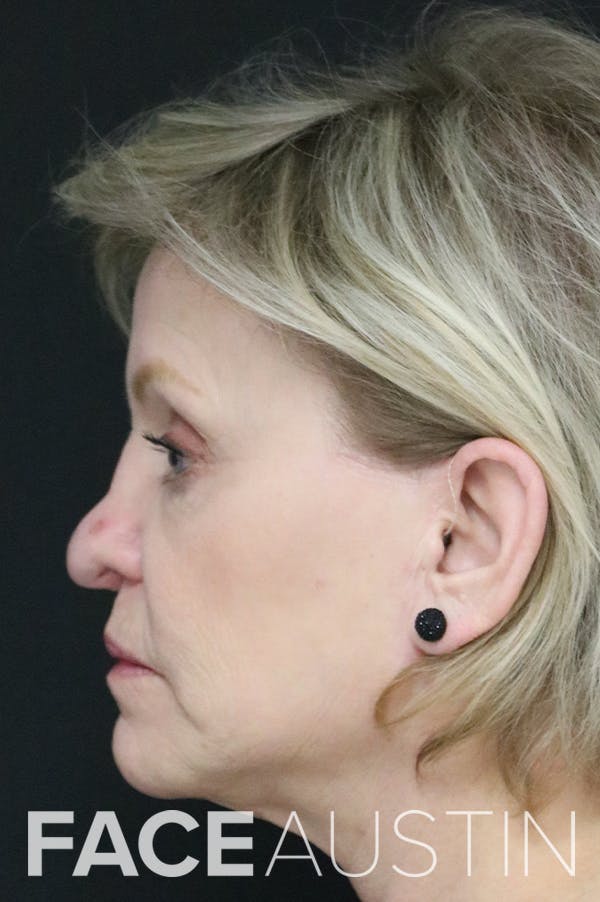 Revision Rhinoplasty Before & After Gallery - Patient 24222644 - Image 1