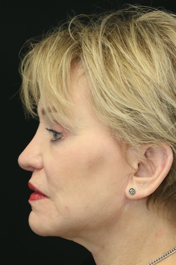 Revision Rhinoplasty Before & After Gallery - Patient 24222644 - Image 2