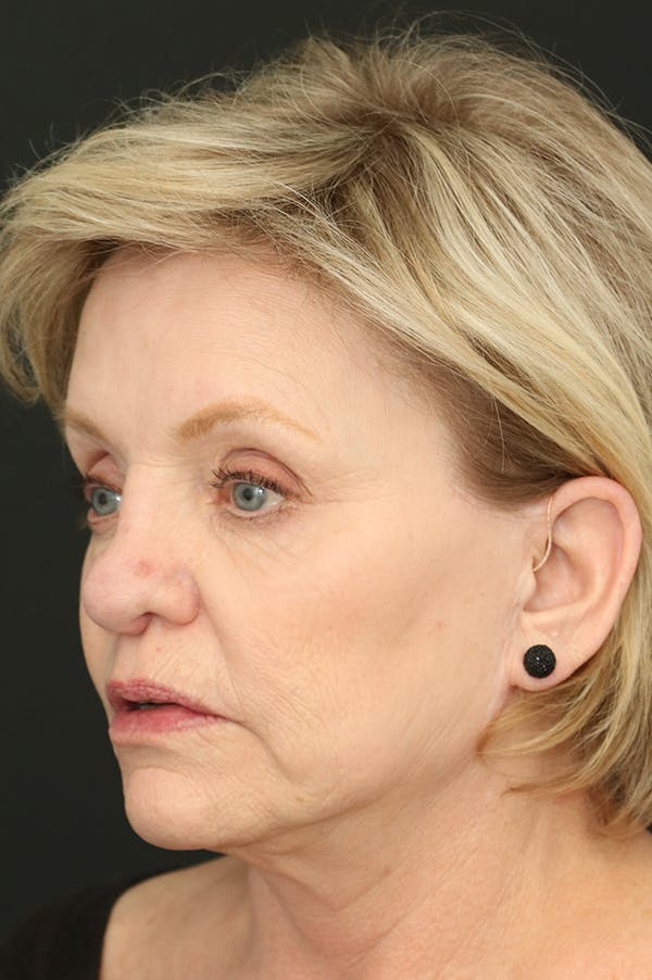 Revision Rhinoplasty Before & After Gallery - Patient 24222644 - Image 3