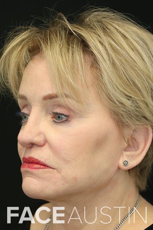 Revision Rhinoplasty Before & After Gallery - Patient 24222644 - Image 4