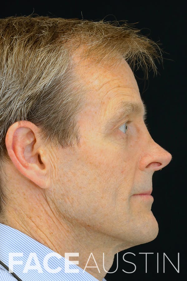 Revision Rhinoplasty Before & After Gallery - Patient 24222645 - Image 1