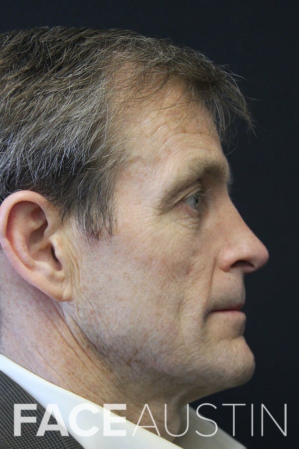 Revision Rhinoplasty Before & After Gallery - Patient 24222645 - Image 2