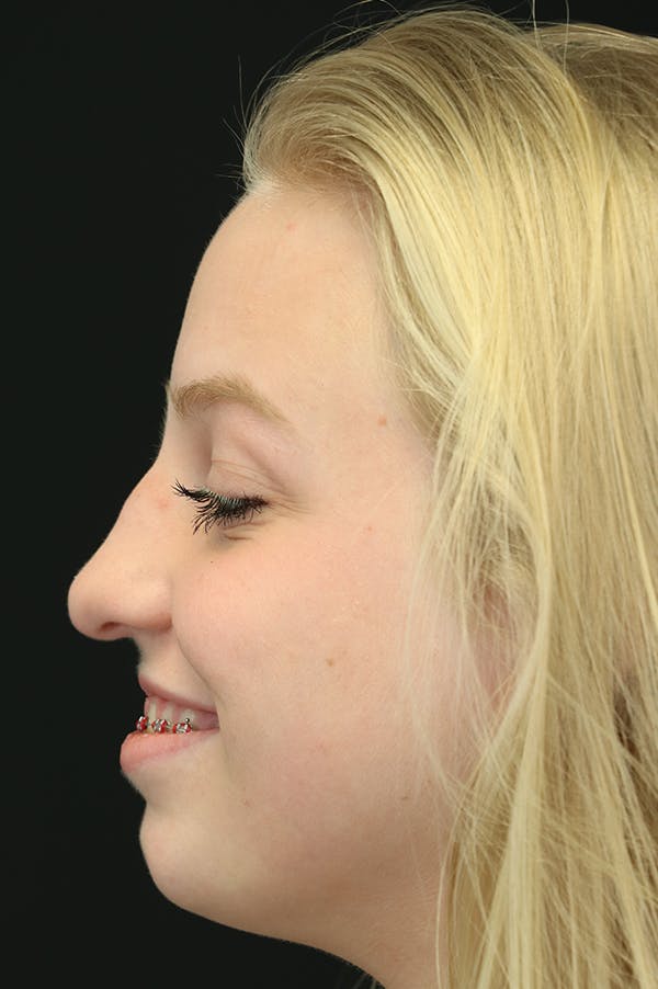 Revision Rhinoplasty Before & After Gallery - Patient 24222646 - Image 1