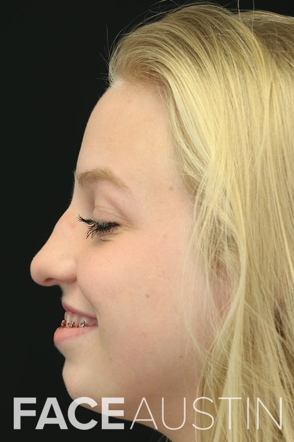 Revision Rhinoplasty Before & After Gallery - Patient 24222646 - Image 1