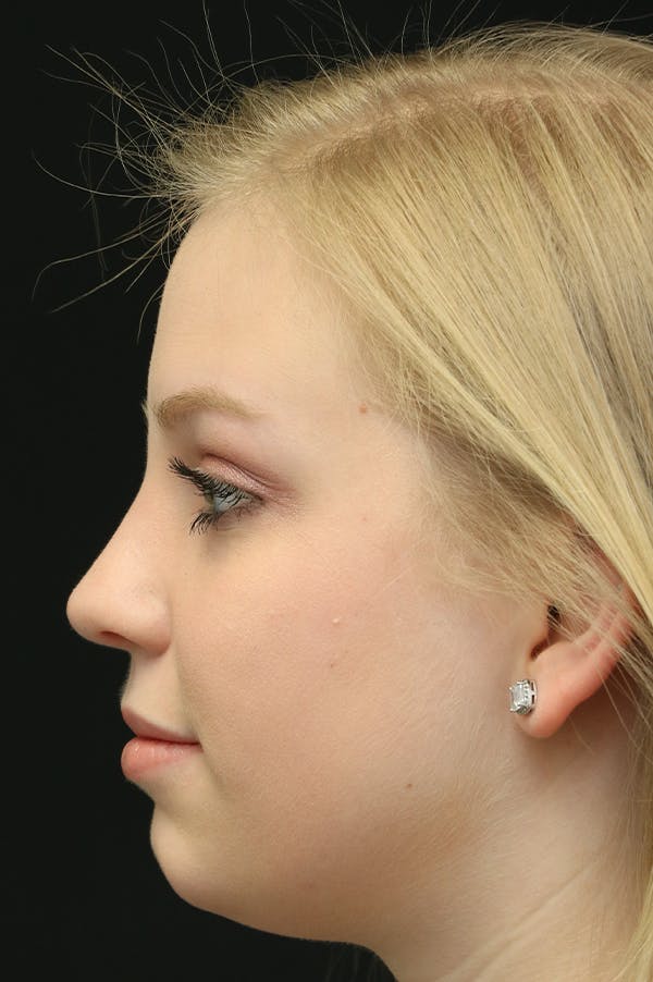 Revision Rhinoplasty Before & After Gallery - Patient 24222646 - Image 2