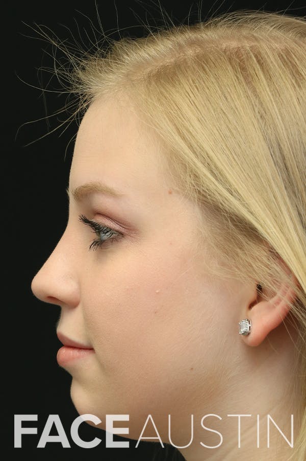 Revision Rhinoplasty Before & After Gallery - Patient 24222646 - Image 2