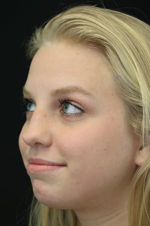 Revision Rhinoplasty female side view