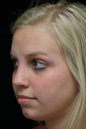 Revision Rhinoplasty female side view
