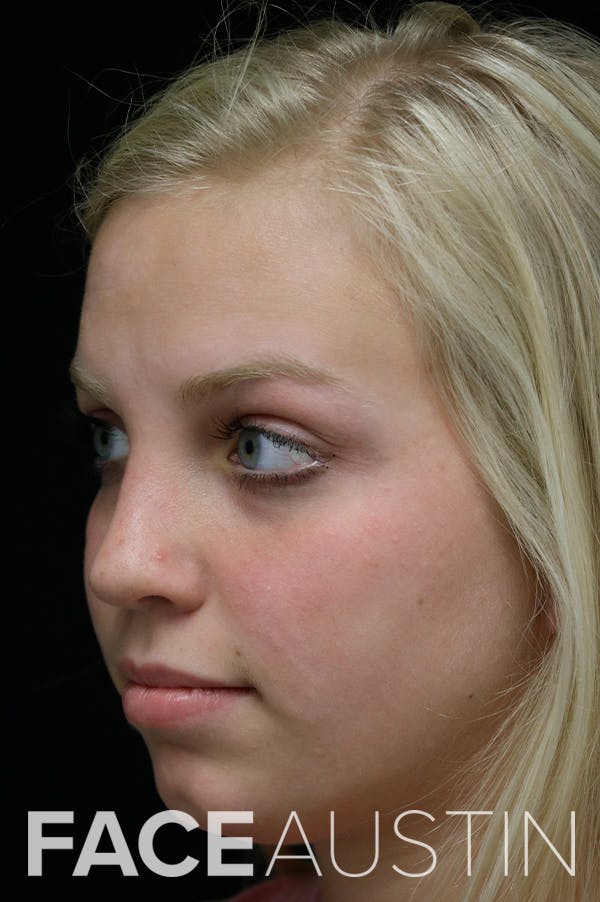 Revision Rhinoplasty Before & After Gallery - Patient 24222646 - Image 4
