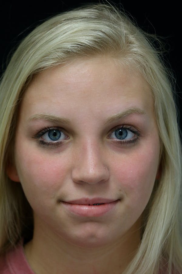 Revision Rhinoplasty Before & After Gallery - Patient 24222646 - Image 6