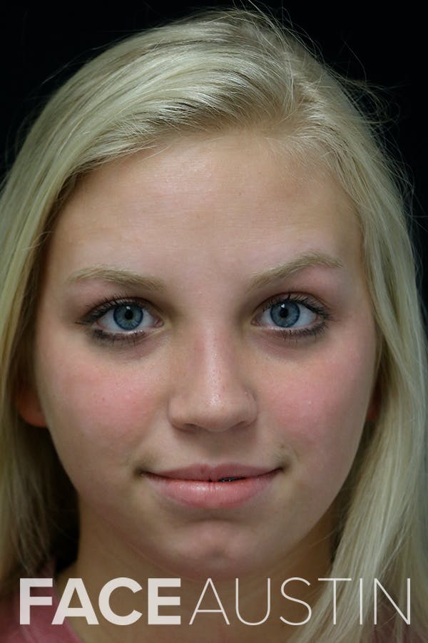 Revision Rhinoplasty Before & After Gallery - Patient 24222646 - Image 6