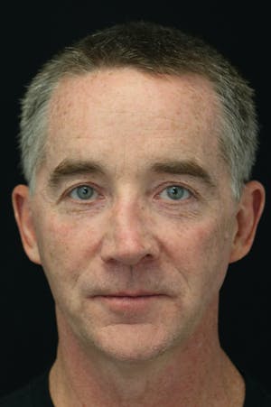 Revision Rhinoplasty male