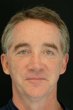 Revision Rhinoplasty male