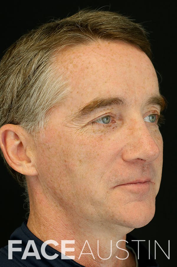 Revision Rhinoplasty Before & After Gallery - Patient 24222647 - Image 4