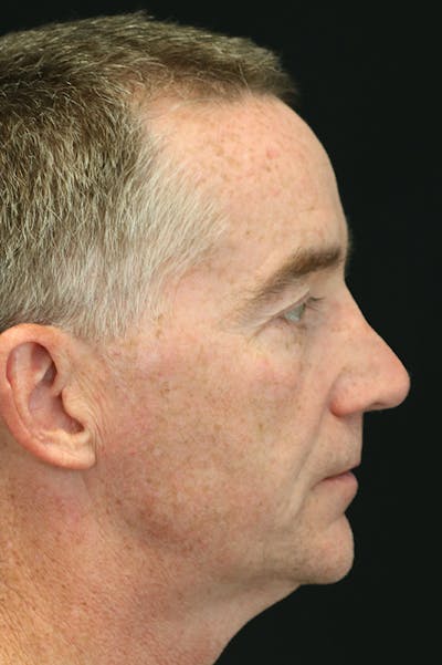 Revision Rhinoplasty Before & After Gallery - Patient 24222647 - Image 1