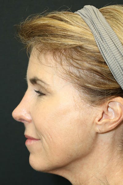 Revision Rhinoplasty Before & After Gallery - Patient 24222648 - Image 2