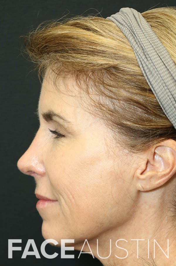 Revision Rhinoplasty Before & After Gallery - Patient 24222648 - Image 2