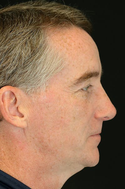 Revision Rhinoplasty Before & After Gallery - Patient 24222647 - Image 2