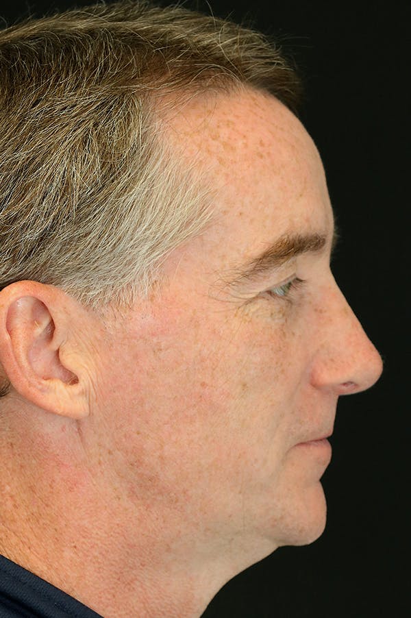 Revision Rhinoplasty Before & After Gallery - Patient 24222647 - Image 2