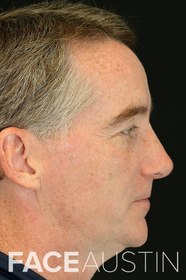Revision Rhinoplasty Before & After Gallery - Patient 24222647 - Image 2