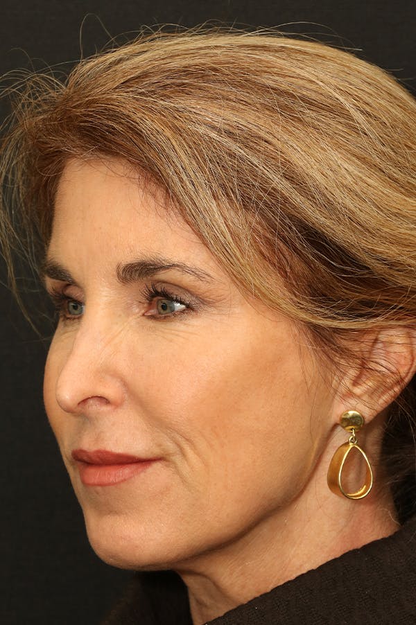Revision Rhinoplasty Before & After Gallery - Patient 24222648 - Image 3