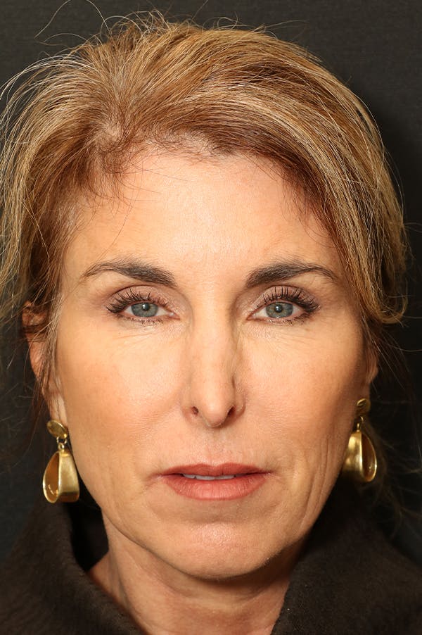 Revision Rhinoplasty Before & After Gallery - Patient 24222648 - Image 5