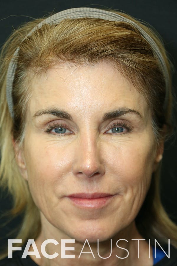 Revision Rhinoplasty Before & After Gallery - Patient 24222648 - Image 6