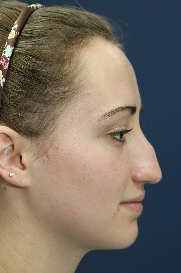 Revision Rhinoplasty Before & After Gallery - Patient 24222649 - Image 1