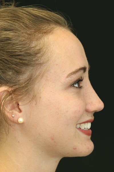 Revision Rhinoplasty Before & After Gallery - Patient 24222649 - Image 2