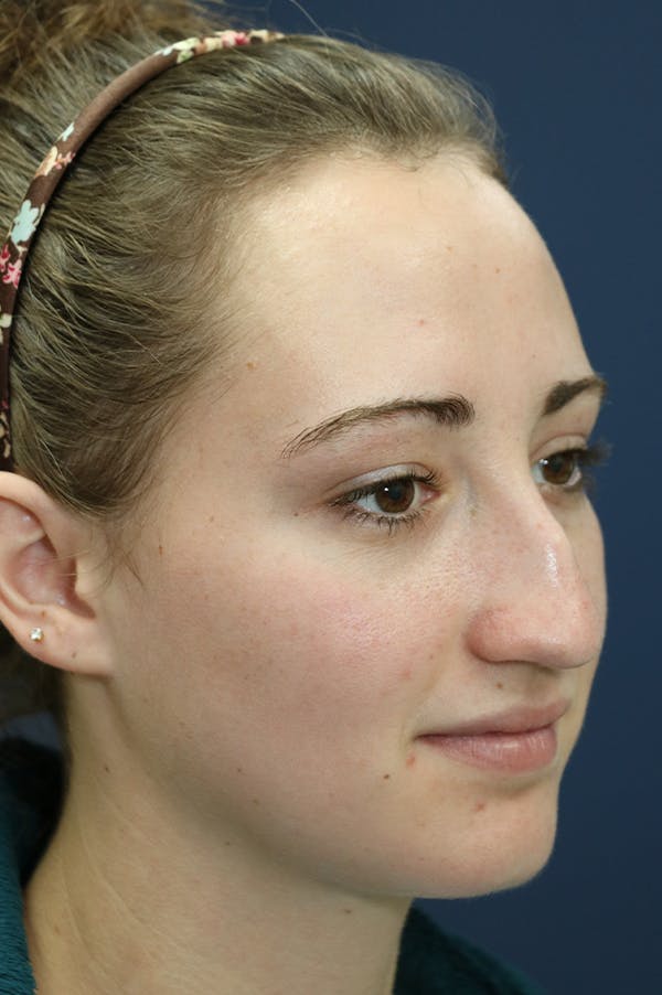 Revision Rhinoplasty Gallery - Patient 24222649 - Image 3