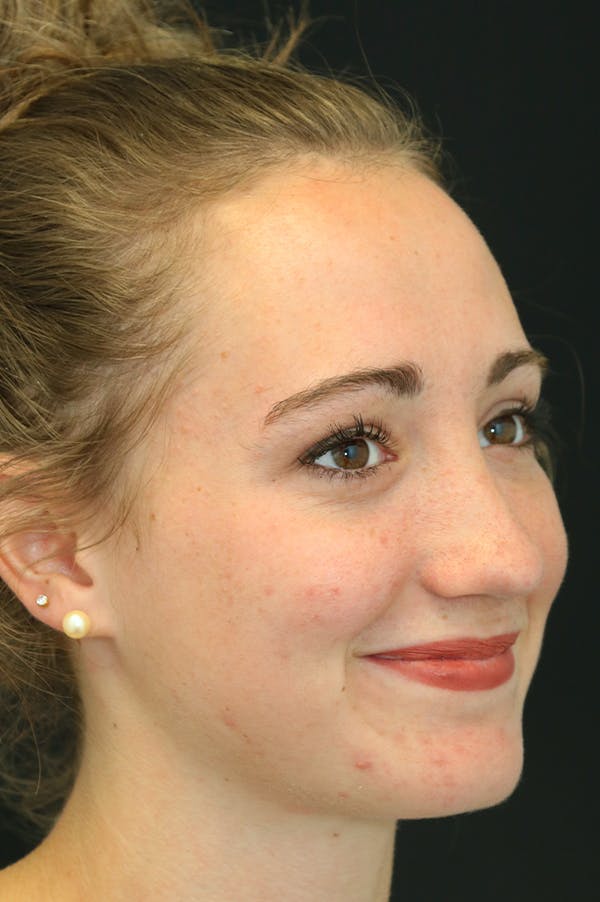 Revision Rhinoplasty Before & After Gallery - Patient 24222649 - Image 4