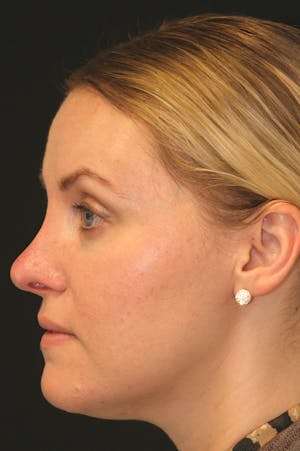 Revision Rhinoplasty female