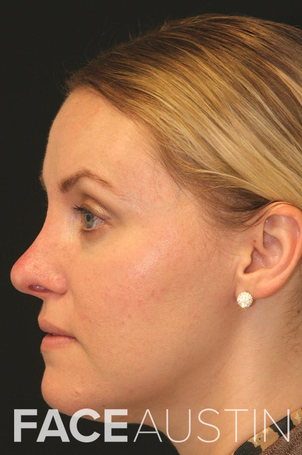 Revision Rhinoplasty Before & After Gallery - Patient 24222650 - Image 1