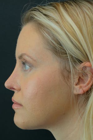 Revision Rhinoplasty female