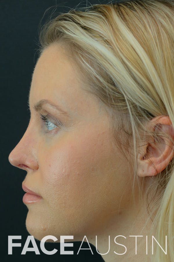 Revision Rhinoplasty Before & After Gallery - Patient 24222650 - Image 2