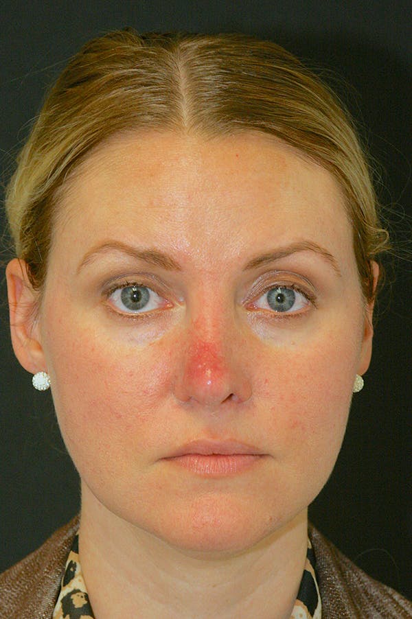 Revision Rhinoplasty Before & After Gallery - Patient 24222650 - Image 3