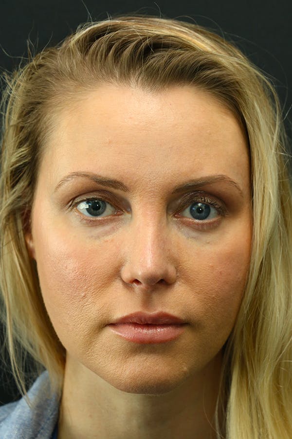 Revision Rhinoplasty Before & After Gallery - Patient 24222650 - Image 4
