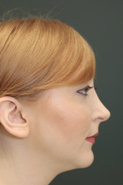 Revision Rhinoplasty Before & After Gallery - Patient 24222651 - Image 1