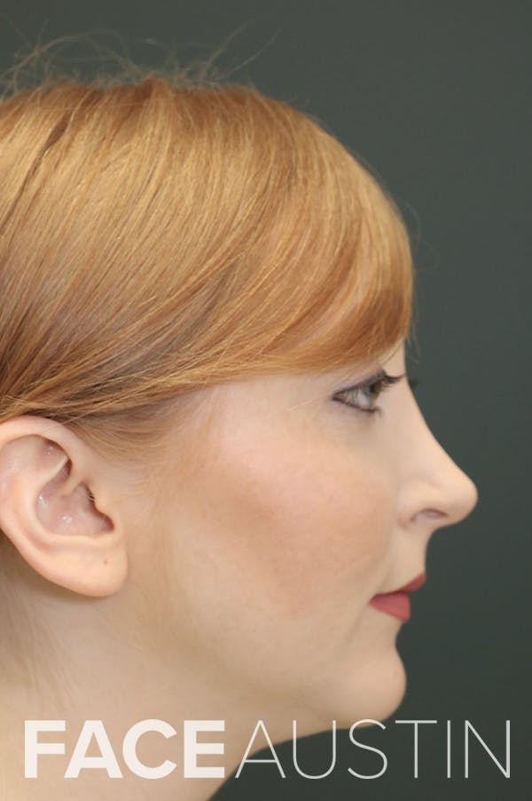 Revision Rhinoplasty Before & After Gallery - Patient 24222651 - Image 1